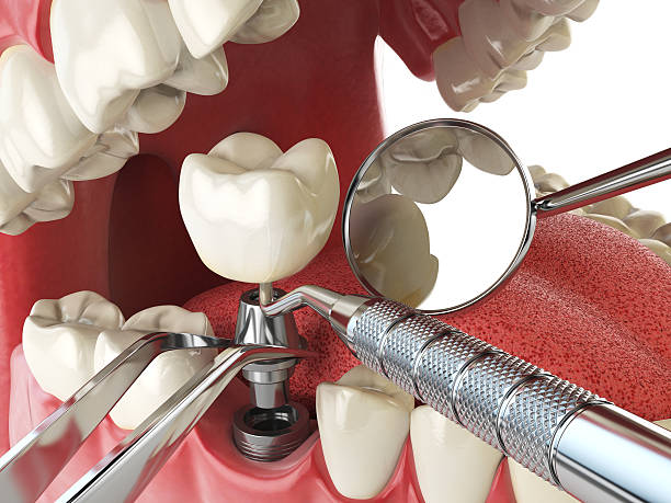 Best Lost Filling or Crown Replacement in Glen Burnie, MD